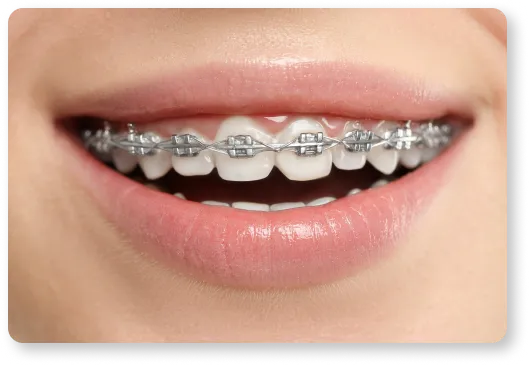 a woman with braces on her teeth