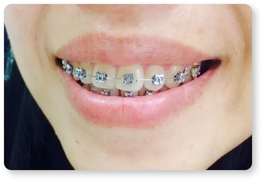 a woman with braces on her teeth