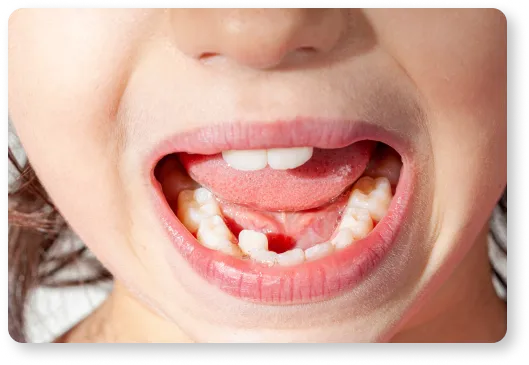 a young girl's mouth with a missing tooth